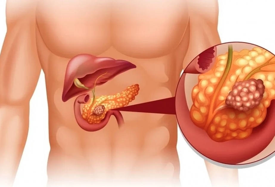 Mədəaltı vəzi xərçəngini 92 faiz dəqiqliklə aşkarlayan test hazırlanıb