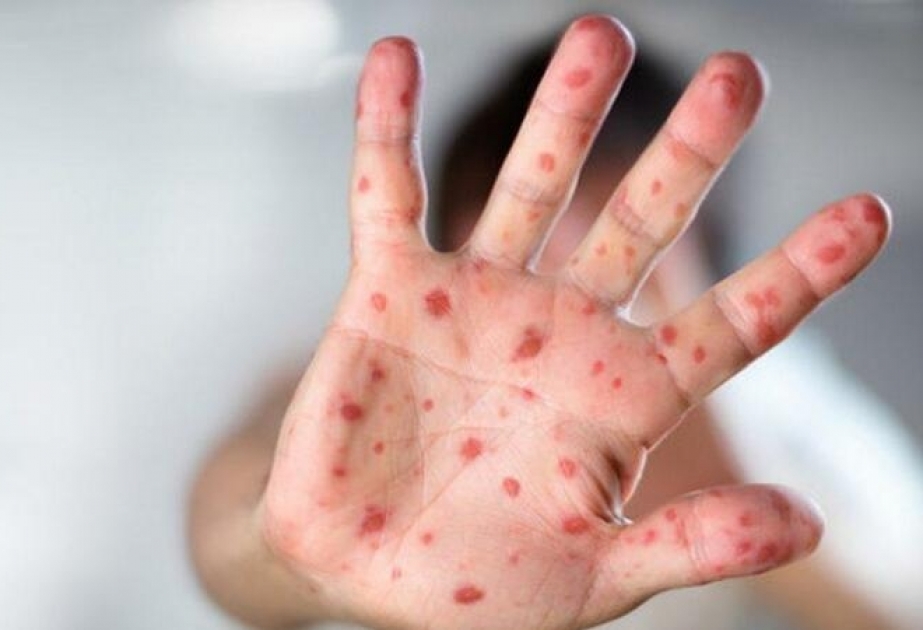 哈萨克斯坦麻疹病例人数破万