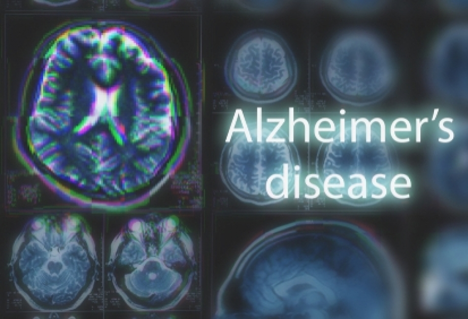 Çox nadir hallarda Alzheimer xəstəliyi yoluxucu ola bilər - Tədqiqat