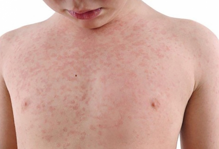 Pediatr: Peyvənd qızılcaya qarşı güclü immunitet yaradır və yoluxma riskini aradan qaldırır