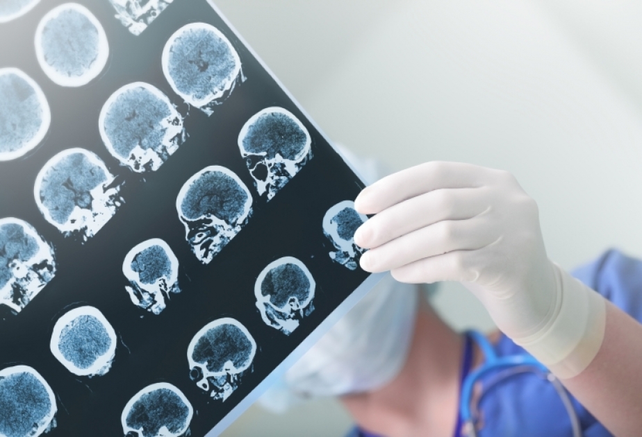 Uşaqlarda epilepsiyaya tez-tez rast gəlinir