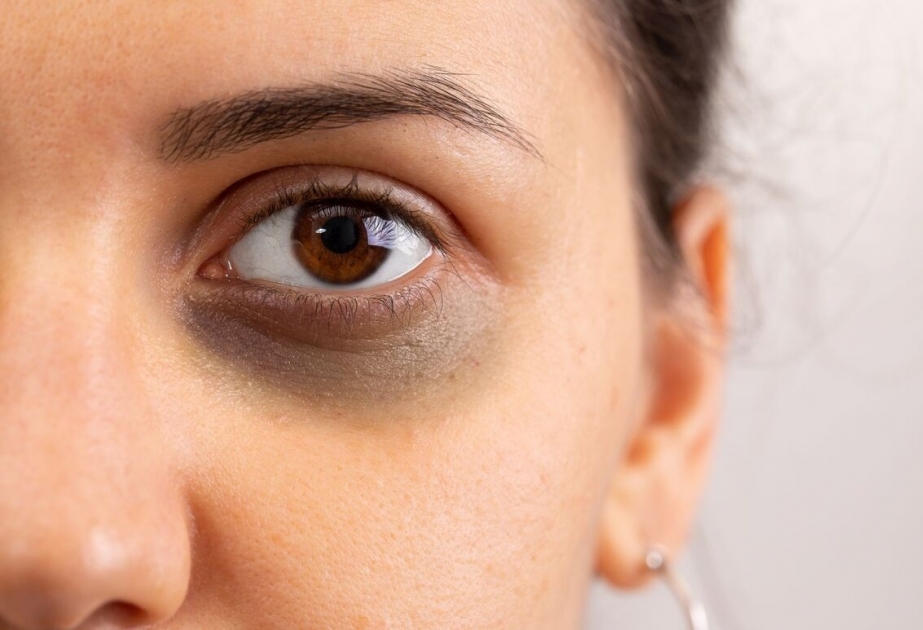 Augenschatten: Ursachen und Tipps