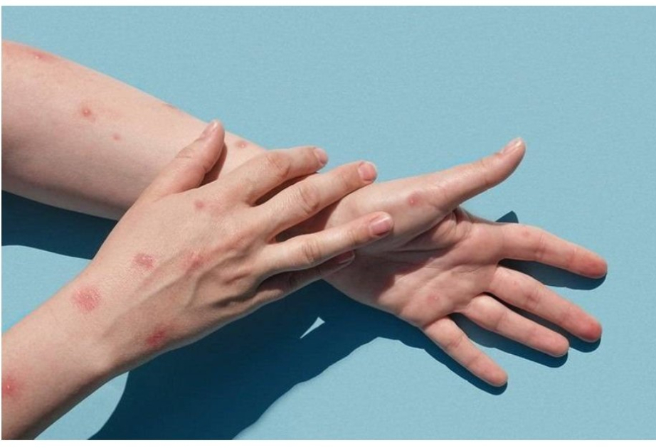 Monkeypox case detected in South Africa