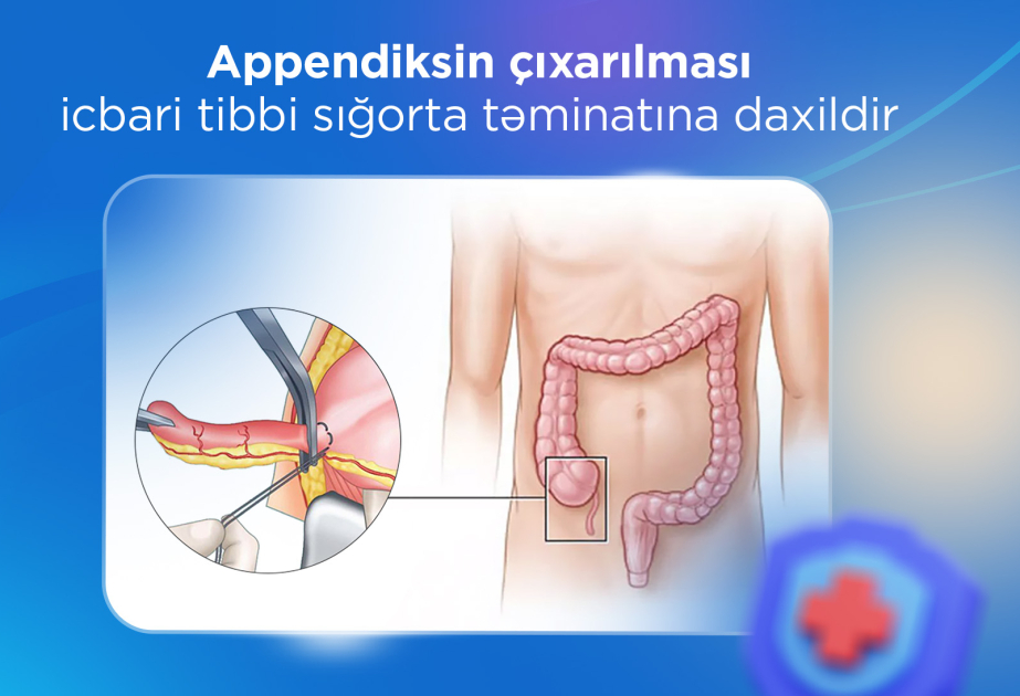 Appendiksin çıxarılması icbari tibbi sığorta təminatına daxildir