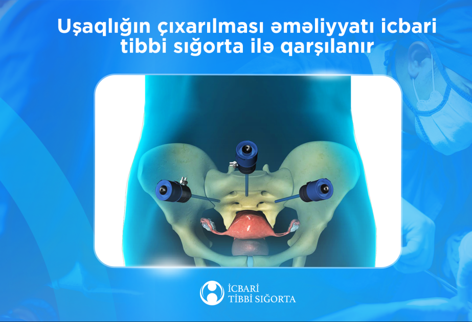 İcbari tibbi sığorta uşaqlığın çıxarılması əməliyyatının xərclərini ödəyir