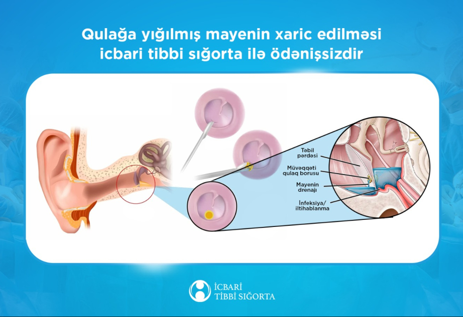 Orta qulağın kəskin iltihabı zamanı cərrahi müalicə xərcləri icbari tibbi sığorta ilə qarşılanır