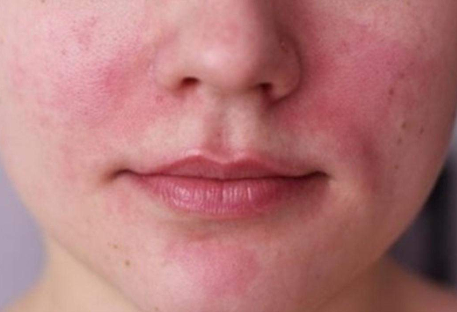Araşdırma: Lupus xəstəliyinin əsas səbəbinin müəyyənləşdirilməsi yeni müalicələrə yol aça bilər