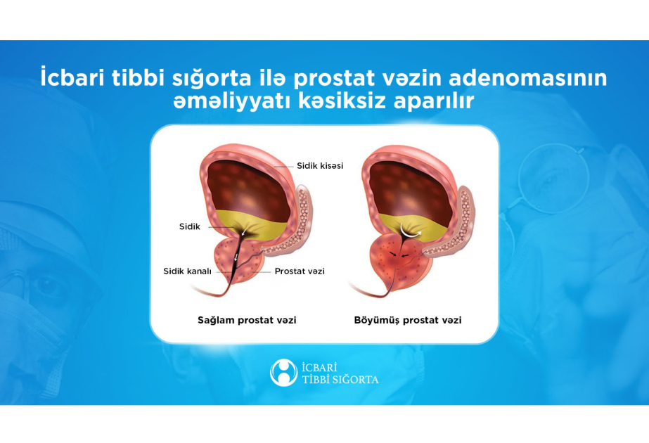İcbari tibbi sığorta ilə prostat vəzinin adenomasının əməliyyatı kəsiksiz aparılır