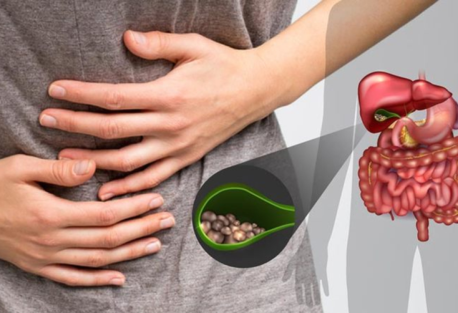 Səhiyyə Nazirliyinin rəsmisi: Öd daşlarını yaradan amilləri vaxtında aparılan müayinələr əsasında aradan qaldırmaq olar