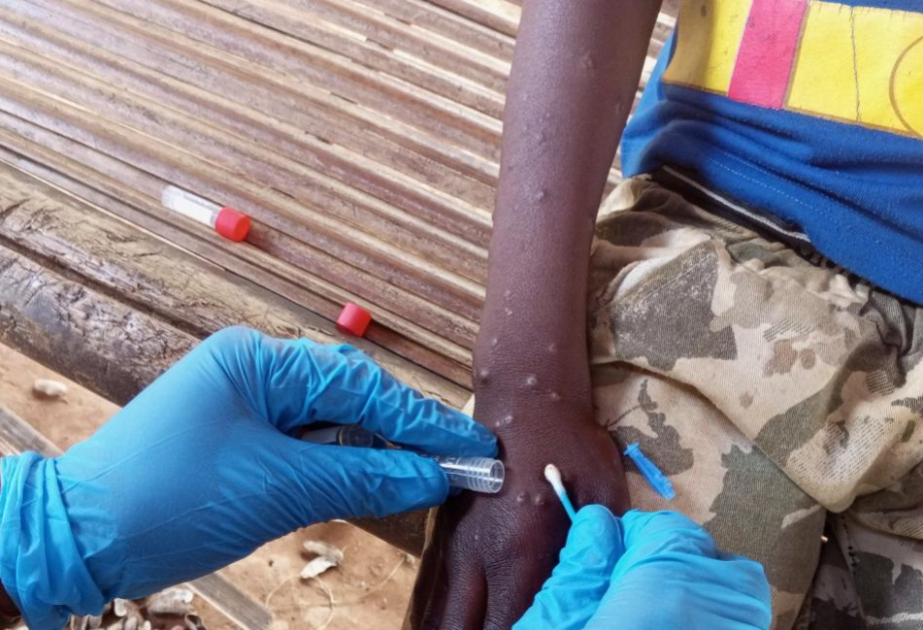 Mpox : Les enfants du Burundi sévèrement affectés par l'épidémie