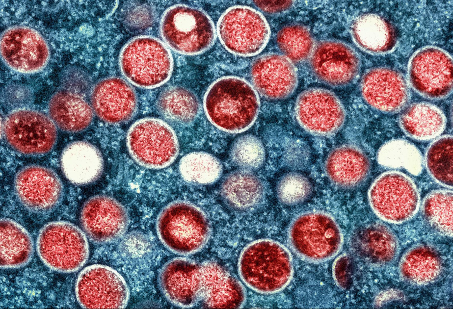 WHO: Neue Mpox-Variante erstmals in Europa übertragen