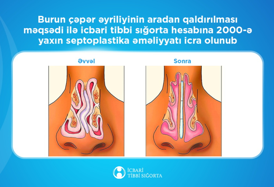 İcbari tibbi sığorta ilə 2 minədək burun çəpəri əməliyyatı yerinə yetirilib