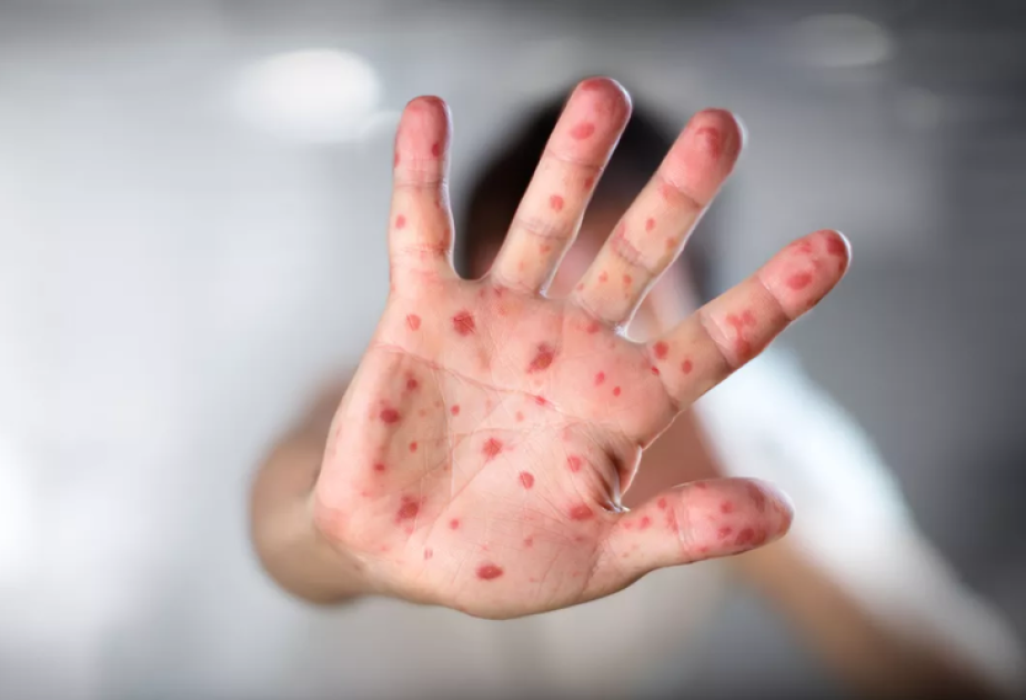 Measles situation in Kyrgyzstan remains tense
