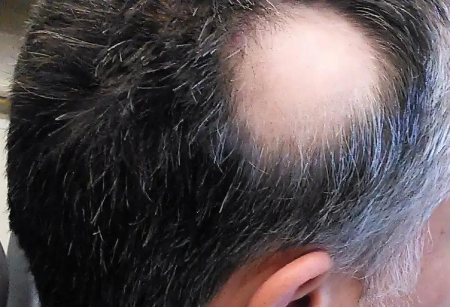 New study reveals protector protein that supports hair regrowth in adults