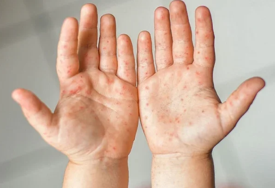 Over 4,800 measles cases registered in Kyrgyzstan, 8 children died