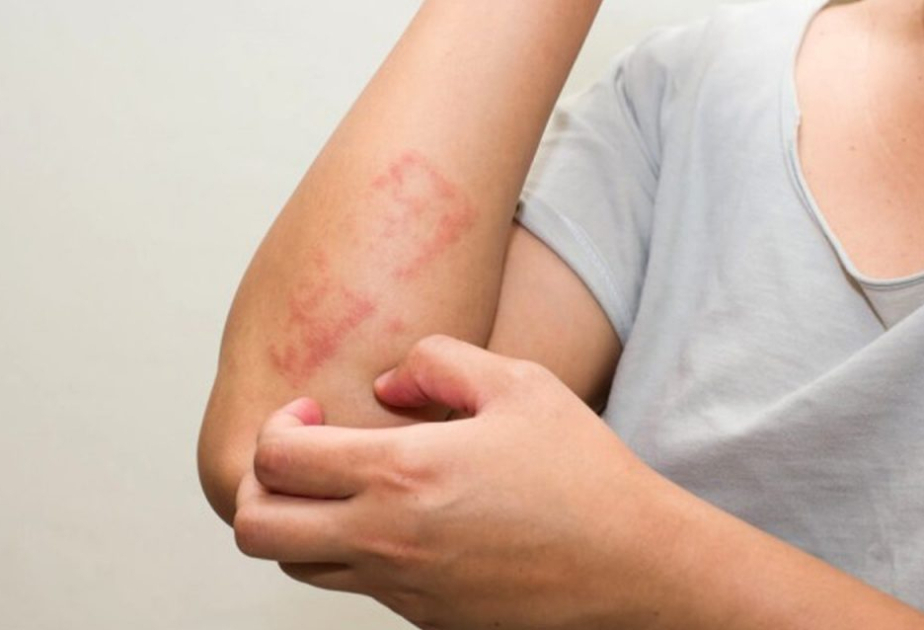 Skin injury may bring on food allergies