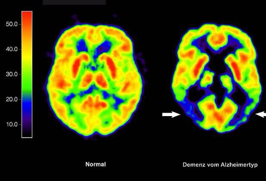 EU authorizes Eisai-Biogen's drug for early Alzheimer's treatment