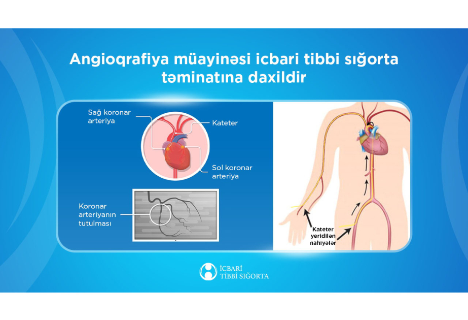 Ötən il icbari tibbi sığorta ilə 50 mindən artıq angioqrafiya müayinəsi aparılıb