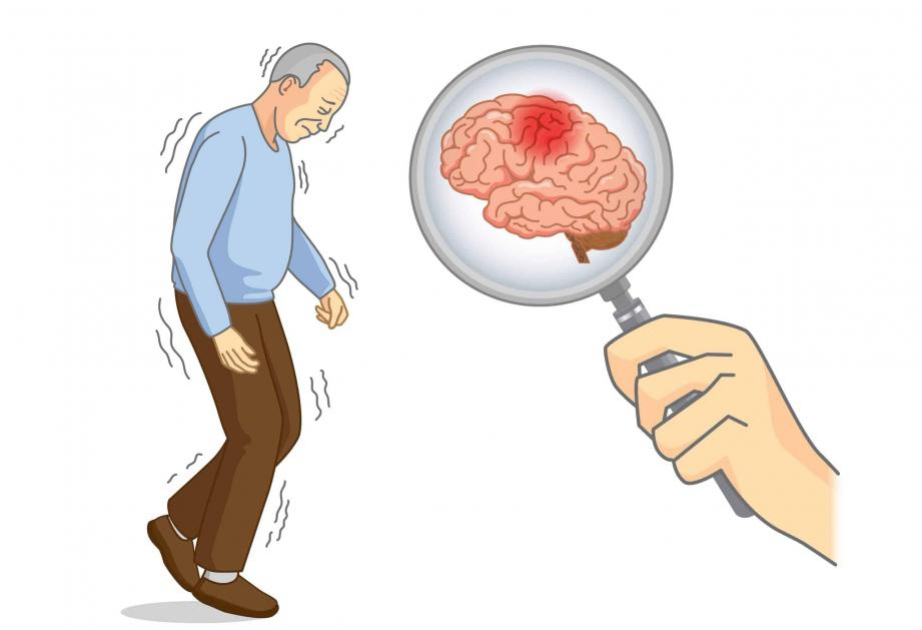 Parkinson's disease might not start in the brain, study finds