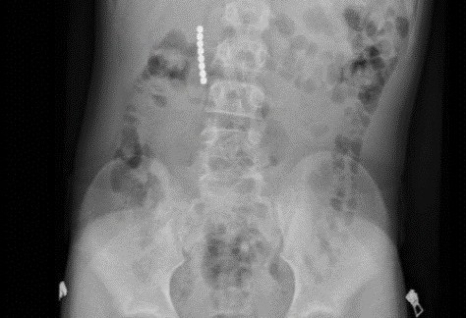 12-year-old undergoes emergency surgery after swallowing magnetic balls