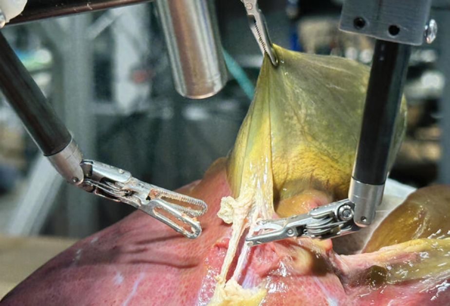 Experimental surgical robot performs gallbladder procedure autonomously
