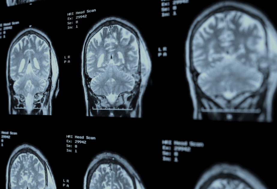New drug could halt Alzheimer’s disease