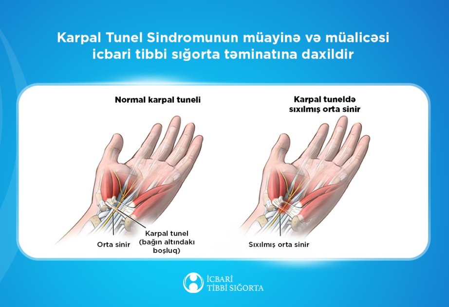 İTSDA: Karpal Tunel Sindromunun müayinə və müalicəsi icbari tibbi sığorta təminatına daxildir