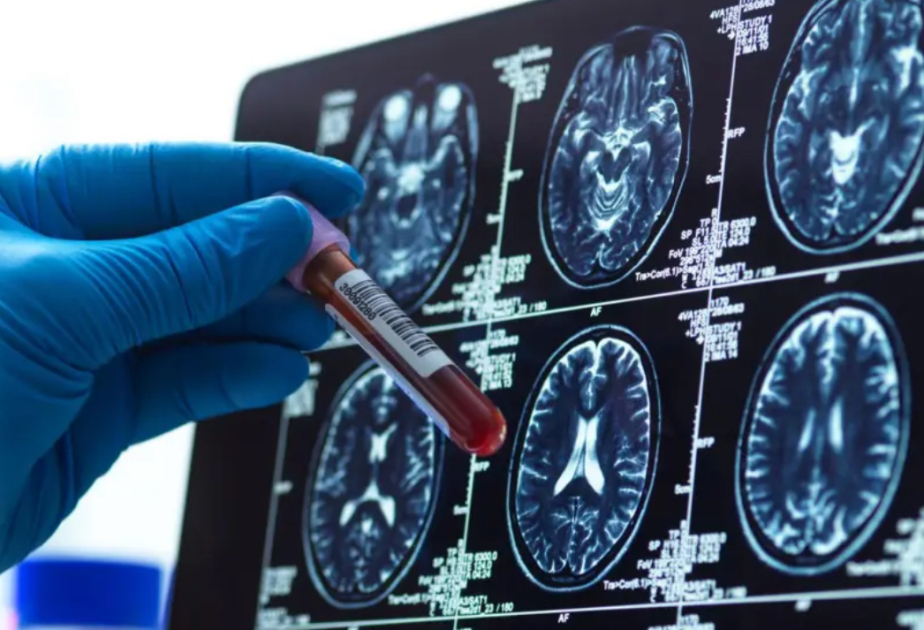 UK trial launches to transform Alzheimer’s diagnosis with simple blood test