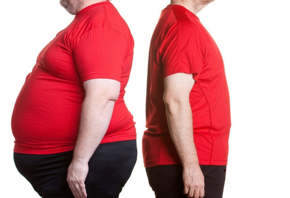 Genetic variants may explain why obesity affects people differently