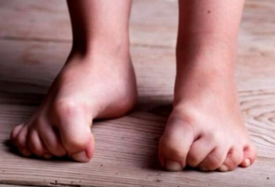 Restless legs treatment slashes increased risk of Parkinson's disease
