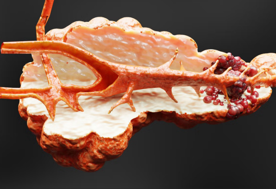 Groundbreaking discovery finds genetic links to pancreatic cancer