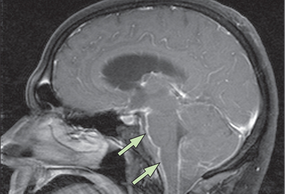 1 confirmed case of meningococcal meningitis reported in western Mongolia
