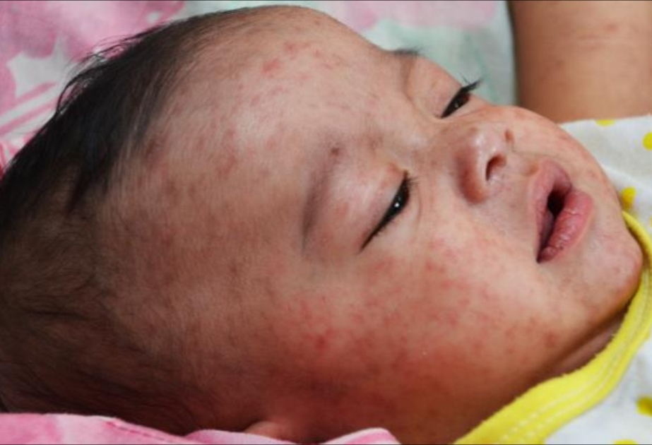 Mongolia's total number of confirmed measles cases exceeds 14,000