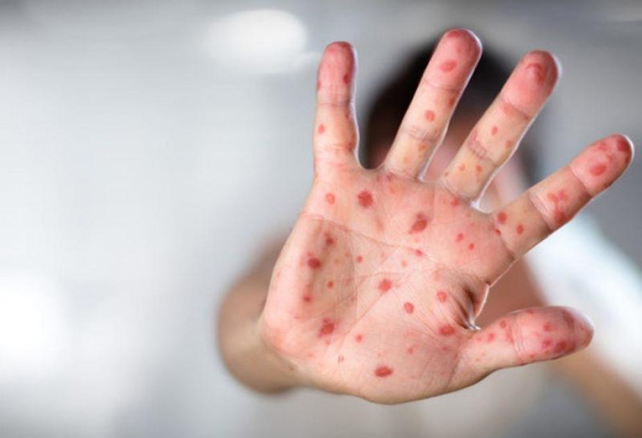 Measles cases dropped in Europe and Central Asia in 2025 compared to the previous year, but risk of outbreaks remains – UNICEF and WHO
