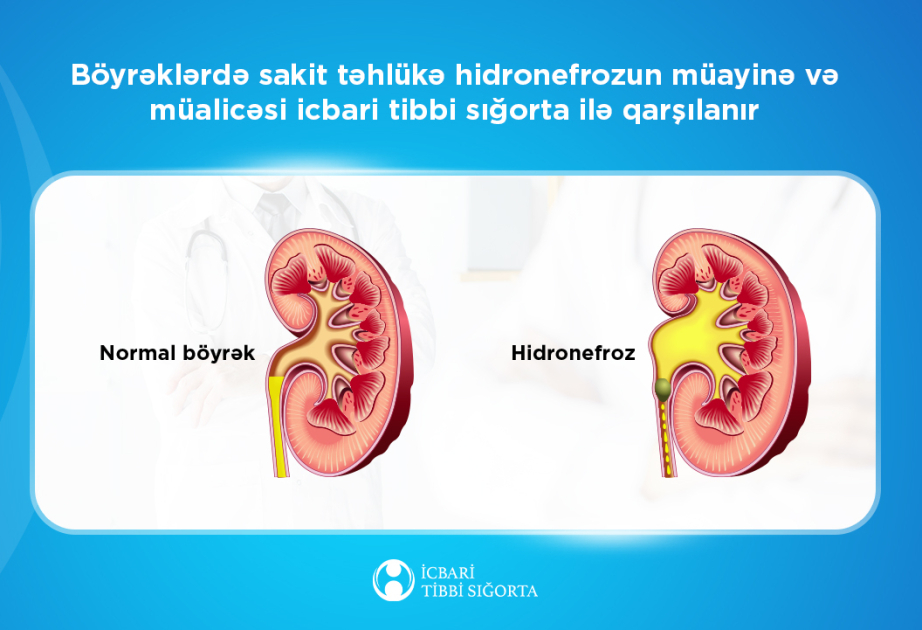 Böyrəklərdə hidronefrozun müayinə və müalicəsi icbari tibbi sığorta ilə qarşılanır