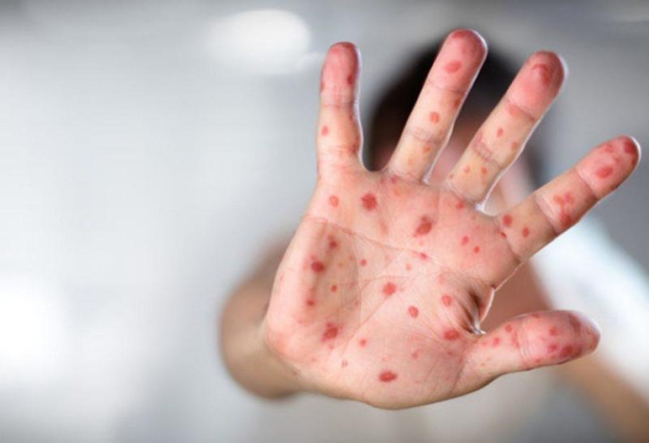 Meksikada qızılca epidemiyası 28 nəfərin ölümünə səbəb olub