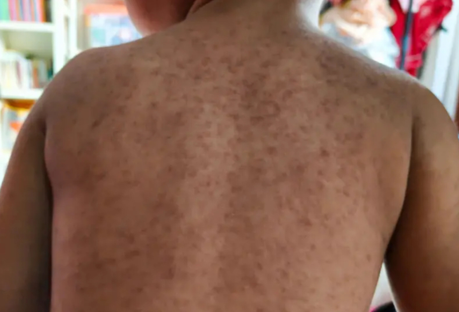 'Fast-spreading' measles outbreak in London leaves dozens of children infected