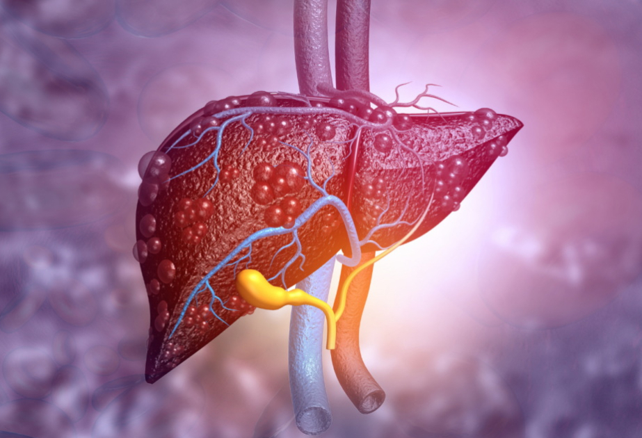Researchers in Australia unveil new tool for early detection of severe liver disease