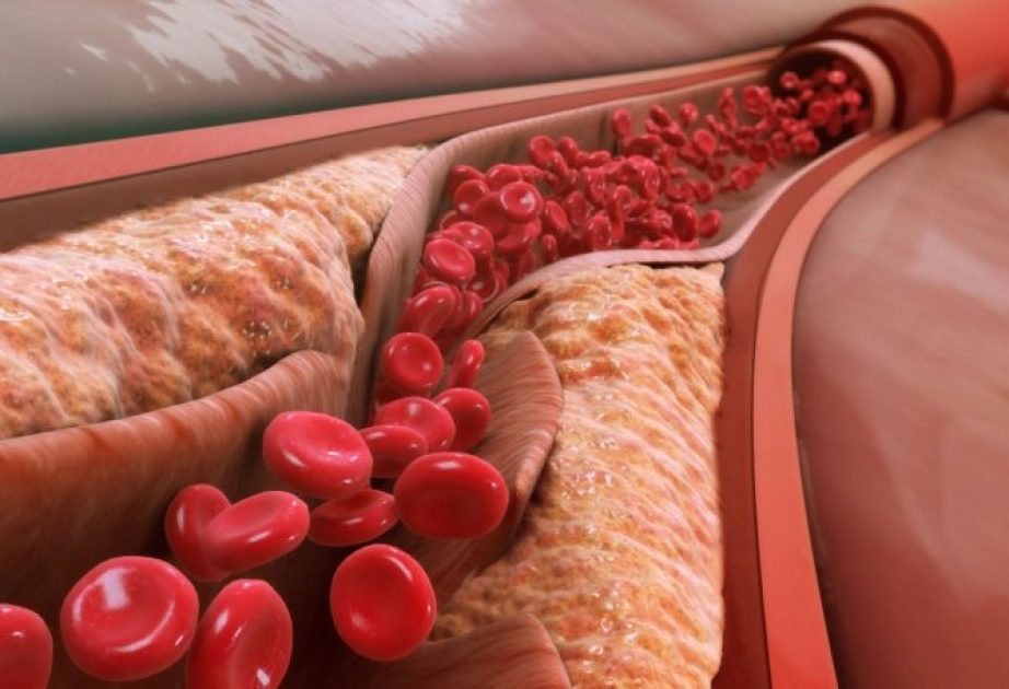 Wie bestimmte Coronaimpfungen zu Hirnthrombosen führten