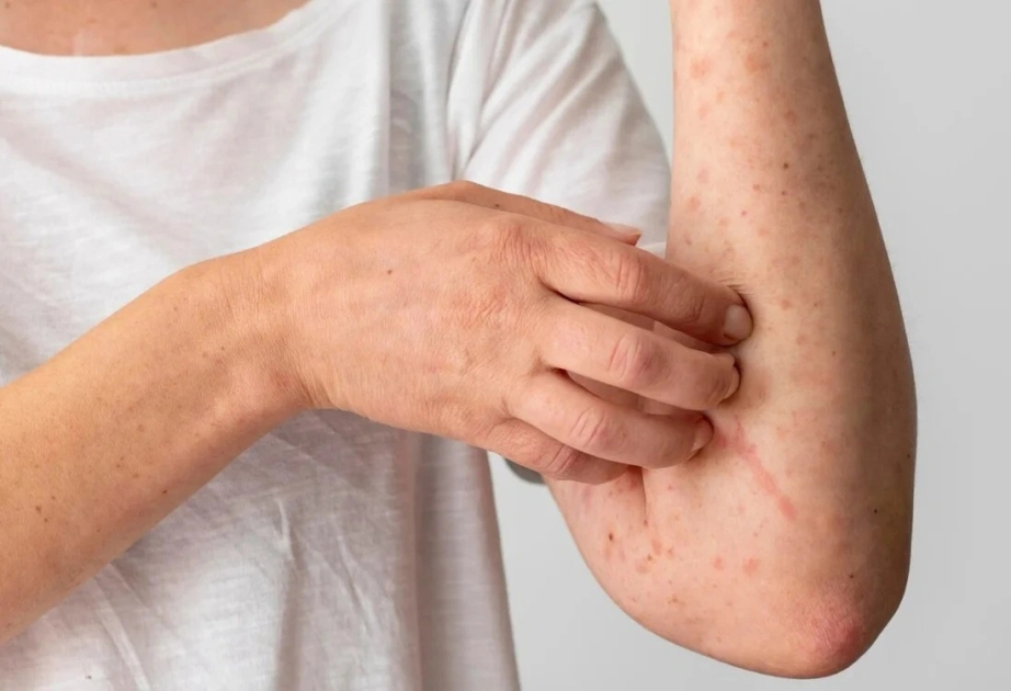 Over 5,000 measles cases recorded in Kazakhstan