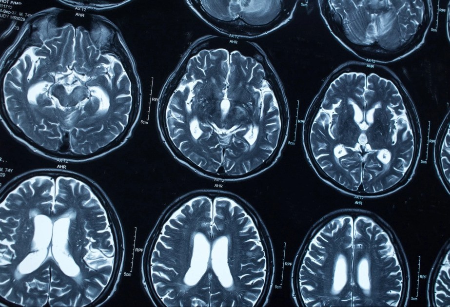Alzheimer's-linked protein crucial for long-term memory: study
