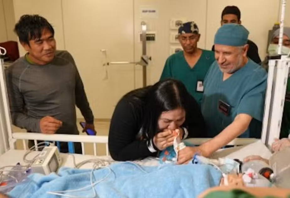 Saudi surgeons separate 4th Filipino conjoined twins