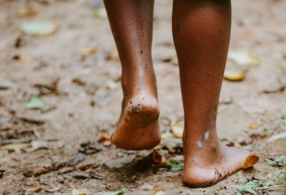 New WHO plan urges stronger action against fungal disease