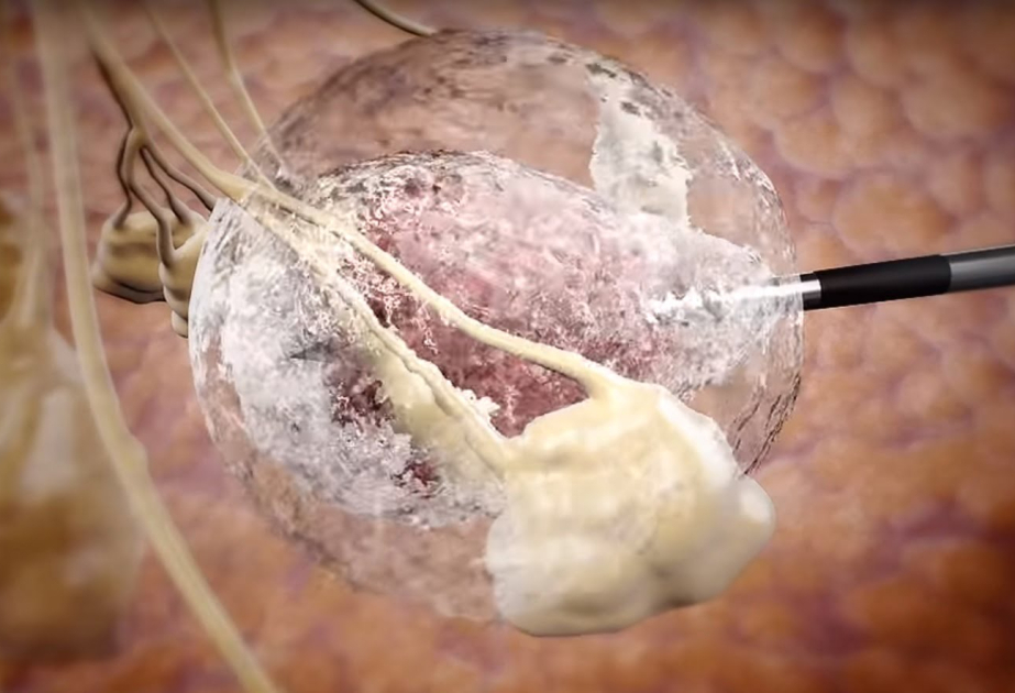 Israeli tumor-freezing technology gains ground in Brazil