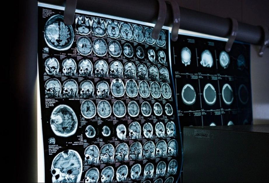Scientists discover how Alzheimer's may destroy brain cells