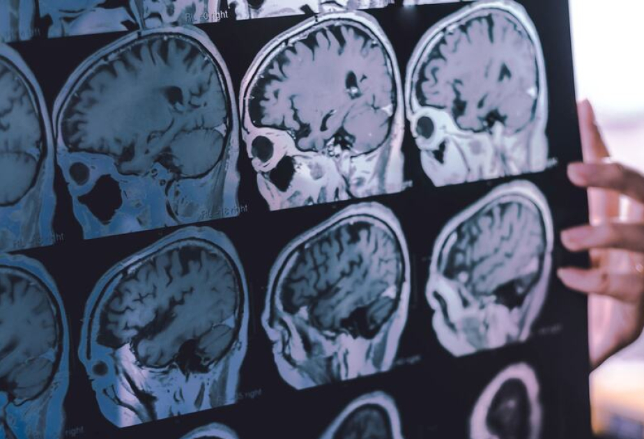 Démence : près de la moitié des cas pourraient être évités, selon l’OMS