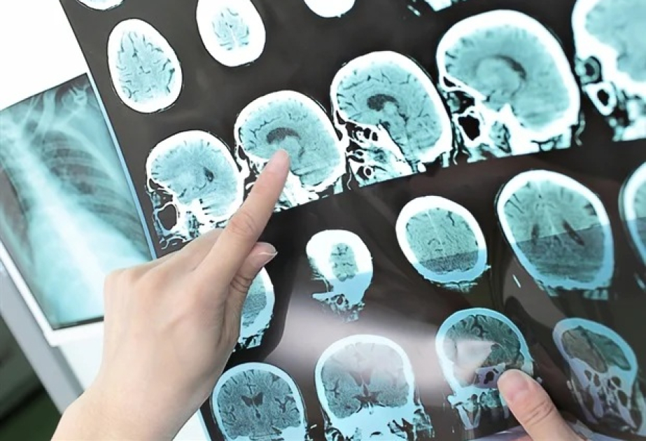 Researchers develop artery-on-a-chip to help predict stroke risk