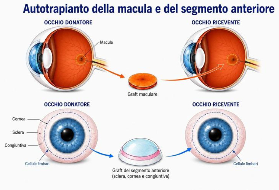 Primer trasplante de retina exitoso del mundo de un ojo a otro