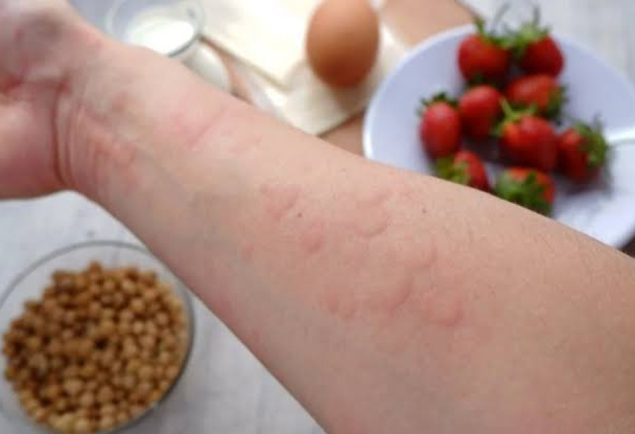 Microbiome-based therapy may increase peanut allergy tolerance in adults