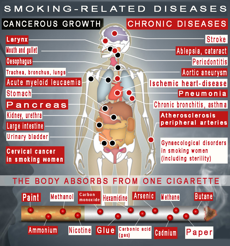 Smoking-Related diseases